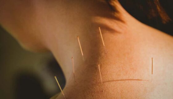 acupuncture_shoulder-2