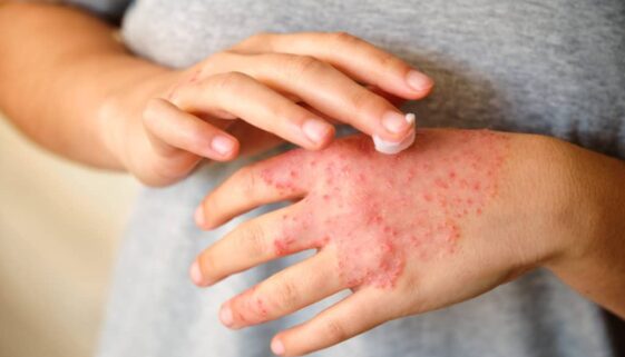 eczema, atopic dermatitis.