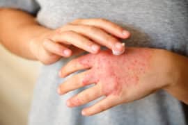 Behandlung von Ekzemen und Neurodermitis mit chinesischer Kräutermedizin