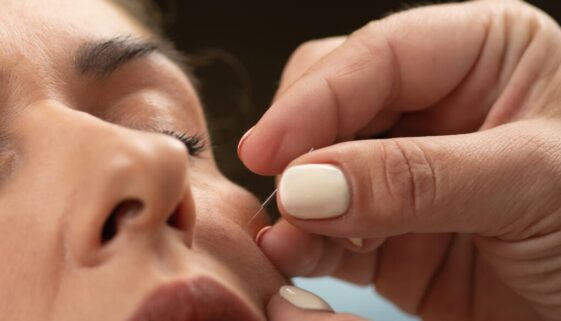 acupuncture-treatment-for-nervus-facialis-2024-10-18-17-53-27-utc-2