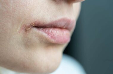 Lippenherpes: Schützen Schüßler Salze?