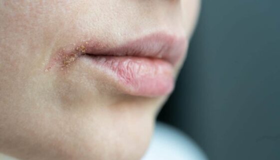 Lippenherpes: Schützen Schüßler Salze?