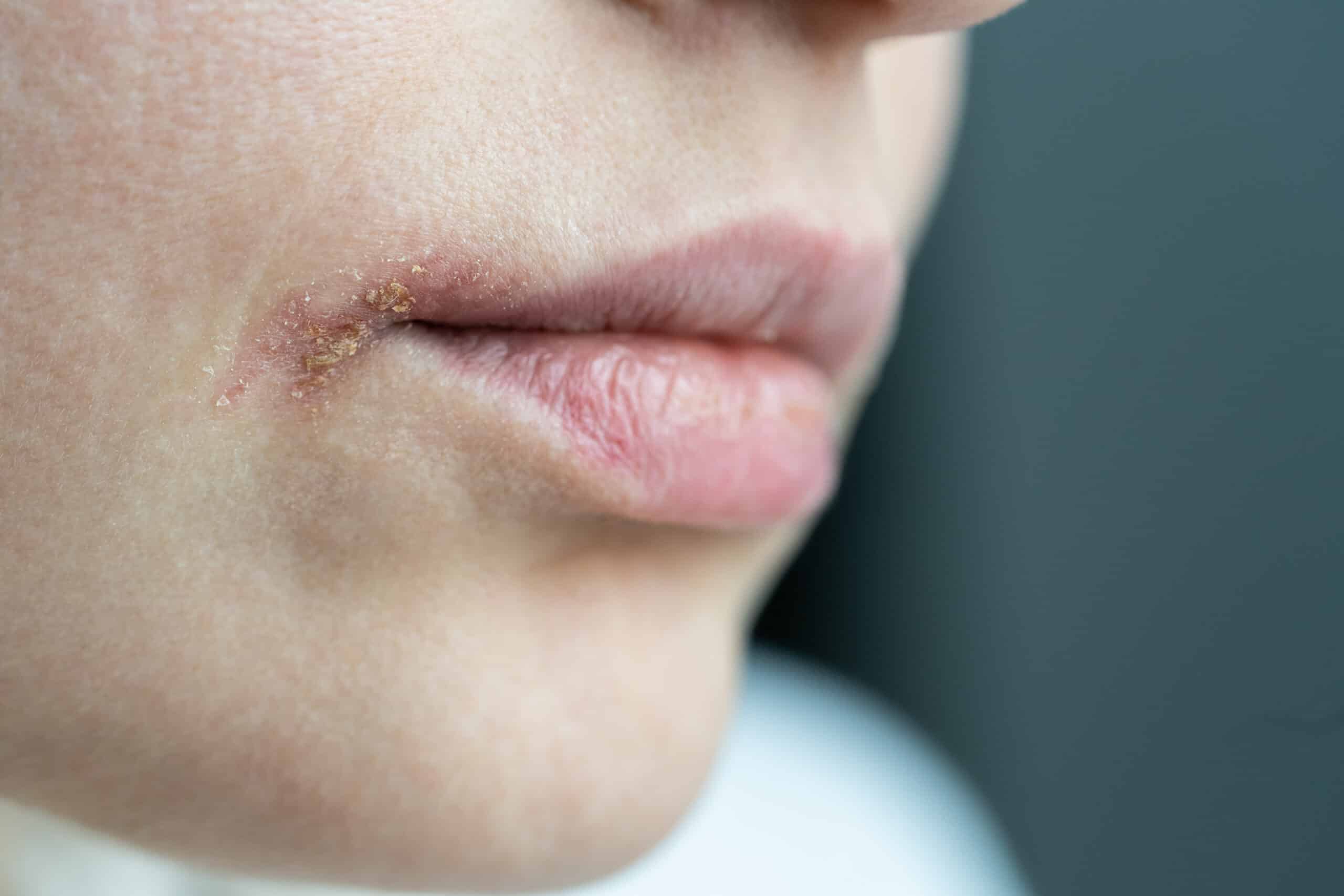 Lippenherpes: Schützen Schüßler Salze?